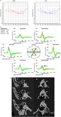 Functional and Objective Audiovestibular Evaluation of Children With Apparent Semicircular Canal Dehiscence–A Case Series in a Pediatric Vestibular Center